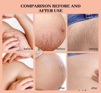 Cream with oil anti-stretch marks